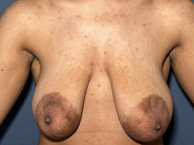 NaturaBra® Mastopexy Before & After Gallery - Patient 141495063 - Image 1