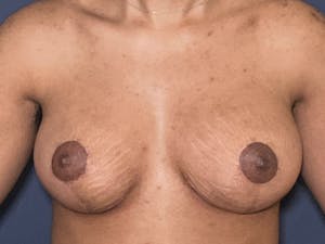 Breast Lift Before and After photos
