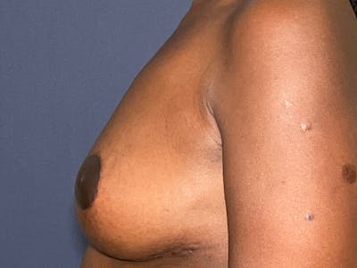 NaturaBra® Mastopexy Before & After Gallery - Patient 104481302 - Image 4