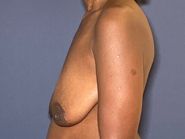 NaturaBra® Mastopexy Before & After Gallery - Patient 104481302 - Image 3