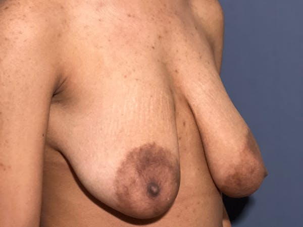 NaturaBra™ Mastopexy Before & After Gallery - Patient 141495063 - Image 3