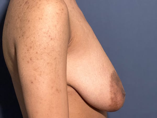 NaturaBra® Mastopexy Before & After Gallery - Patient 141495063 - Image 5
