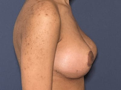 NaturaBra® Mastopexy Before & After Gallery - Patient 141495063 - Image 6