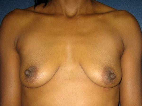 Breast Augmentation Before & After Gallery - Patient 4455138 - Image 1