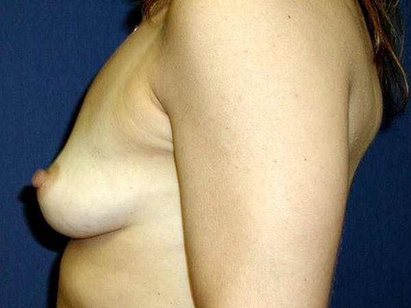 Breast Augmentation Before & After Gallery - Patient 4455256 - Image 3