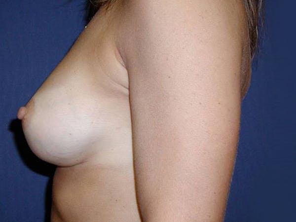 Breast Augmentation Before & After Gallery - Patient 4455256 - Image 4