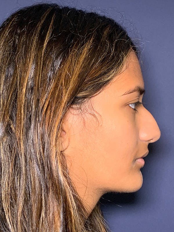 Septoplasty Before & After Gallery - Patient 141789235 - Image 3