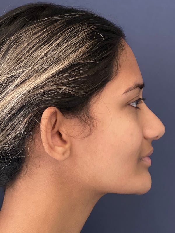 Rhinoplasty Before & After Gallery - Patient 141789234 - Image 4