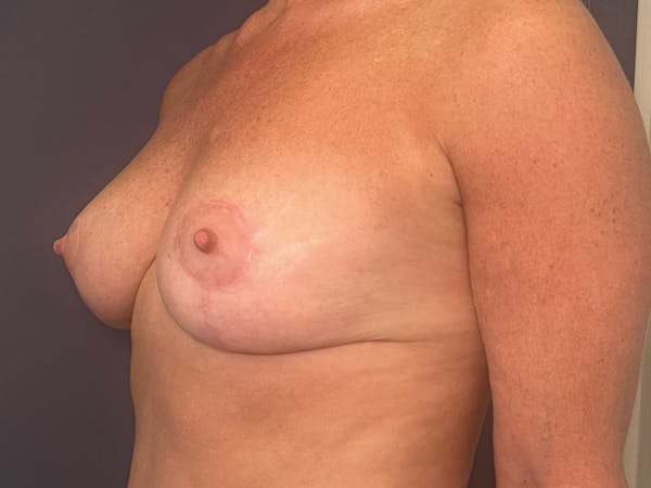 NaturaBra® Mastopexy Before & After Gallery - Patient 142025333 - Image 4