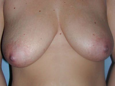 NaturaBra® Mastopexy Before & After Gallery - Patient 4488486 - Image 1