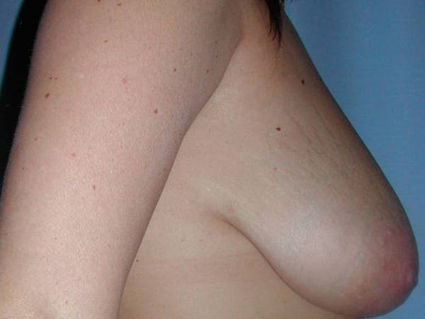 NaturaBra® Mastopexy Before & After Gallery - Patient 4488486 - Image 5