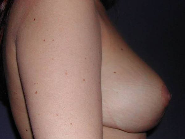 NaturaBra® Mastopexy Before & After Gallery - Patient 4488486 - Image 6