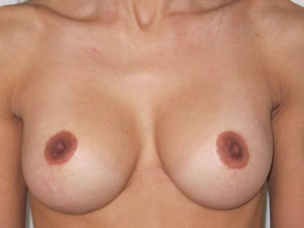 NaturaBra® Mastopexy Before & After Gallery - Patient 4488485 - Image 2
