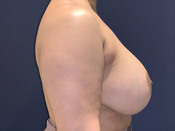 Breast Lift with Fat Grafting Before & After Gallery - Patient 4488534 - Image 3