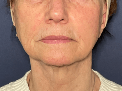 TRL Laser Before & After Gallery - Patient 142896798 - Image 1