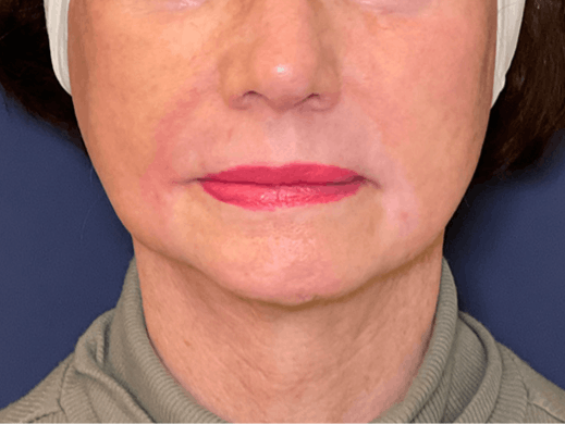 TRL Laser Before & After Gallery - Patient 142896798 - Image 2