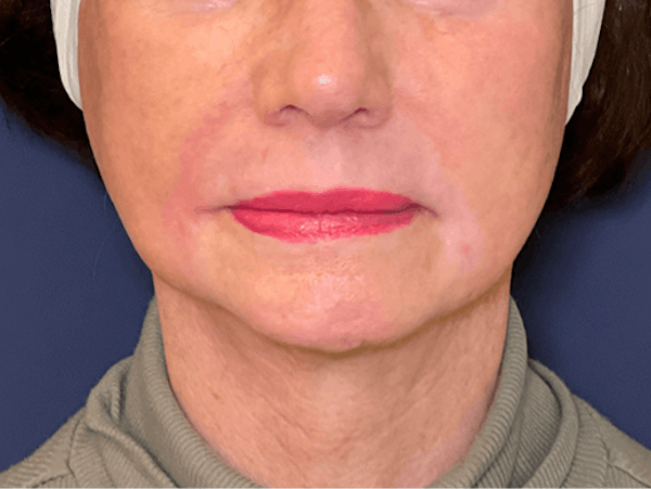 TRL Laser Before & After Gallery - Patient 142896798 - Image 2