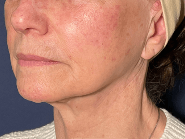 TRL Laser Before & After Gallery - Patient 142896798 - Image 3