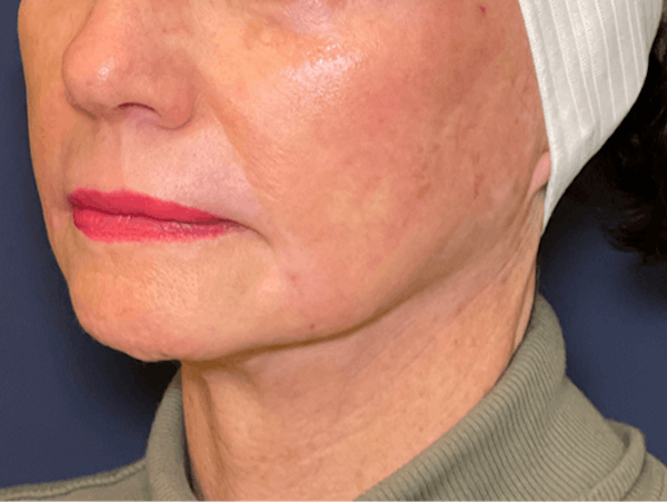 TRL Laser Before & After Gallery - Patient 142896798 - Image 4