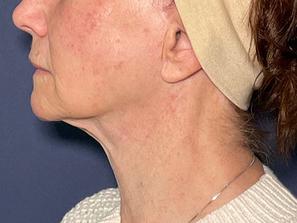 TRL Laser Before & After Gallery - Patient 142896798 - Image 5