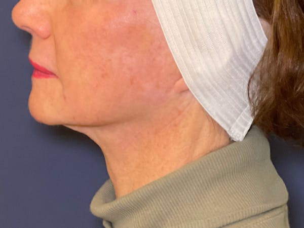 TRL Laser Before & After Gallery - Patient 142896798 - Image 6