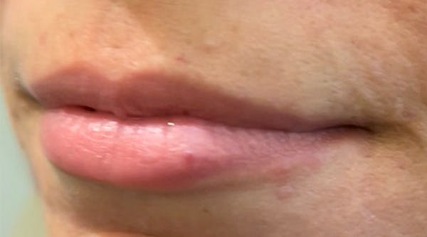 Lip Augmentation Before & After Gallery - Patient 143443075 - Image 1