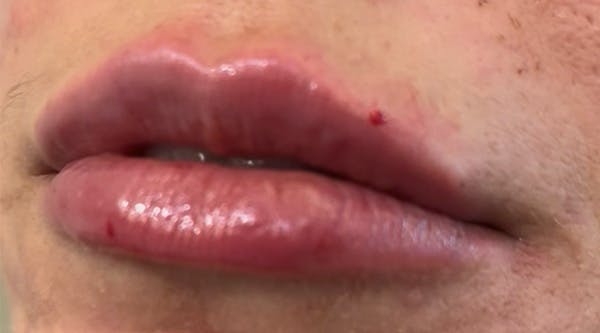 Lip Augmentation Before & After Gallery - Patient 143443075 - Image 2