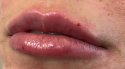 Lip Augmentation Before & After Gallery - Patient 143443075 - Image 2