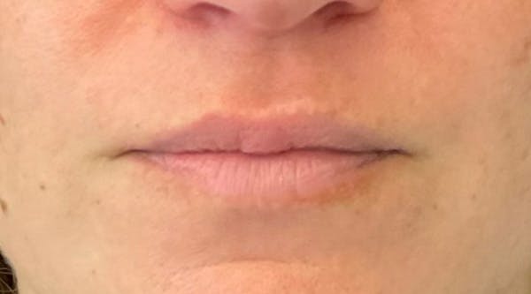 Lip Augmentation Before & After Gallery - Patient 143443076 - Image 1