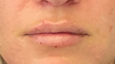 Lip Augmentation Before & After Gallery - Patient 143443076 - Image 2