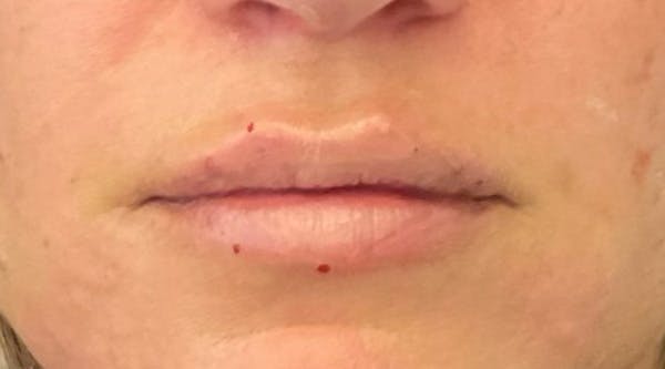Lip Augmentation Before & After Gallery - Patient 143443076 - Image 2