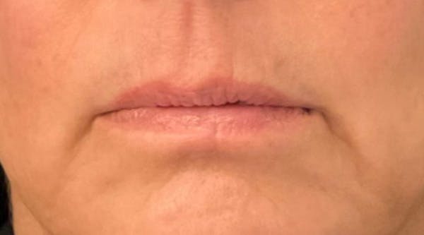 Lip Augmentation Before & After Gallery - Patient 143443077 - Image 1