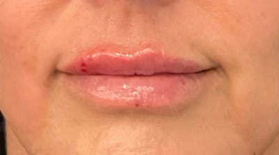 Lip Augmentation Before & After Gallery - Patient 143443077 - Image 2