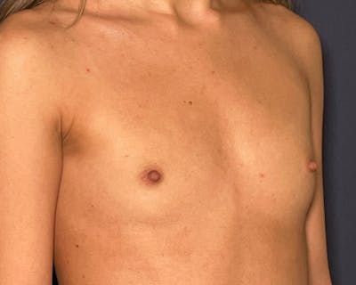 Breast Augmentation Before & After Gallery - Patient 143675892 - Image 1