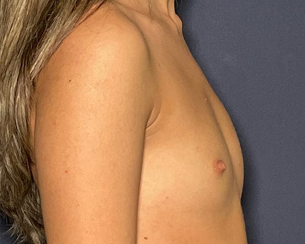 Breast Augmentation Before & After Gallery - Patient 143675892 - Image 3