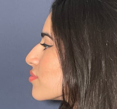  Liquid Rhinoplasty Before & After Gallery - Patient 144174836 - Image 1