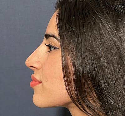  Liquid Rhinoplasty Before & After Gallery - Patient 144174836 - Image 2