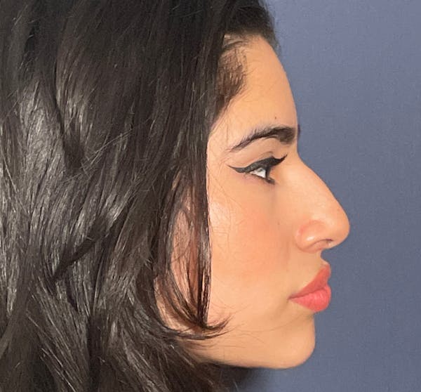  Liquid Rhinoplasty Before & After Gallery - Patient 144174836 - Image 3