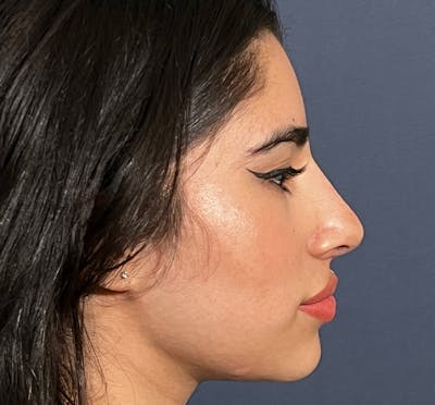  Liquid Rhinoplasty Before & After Gallery - Patient 144174836 - Image 4