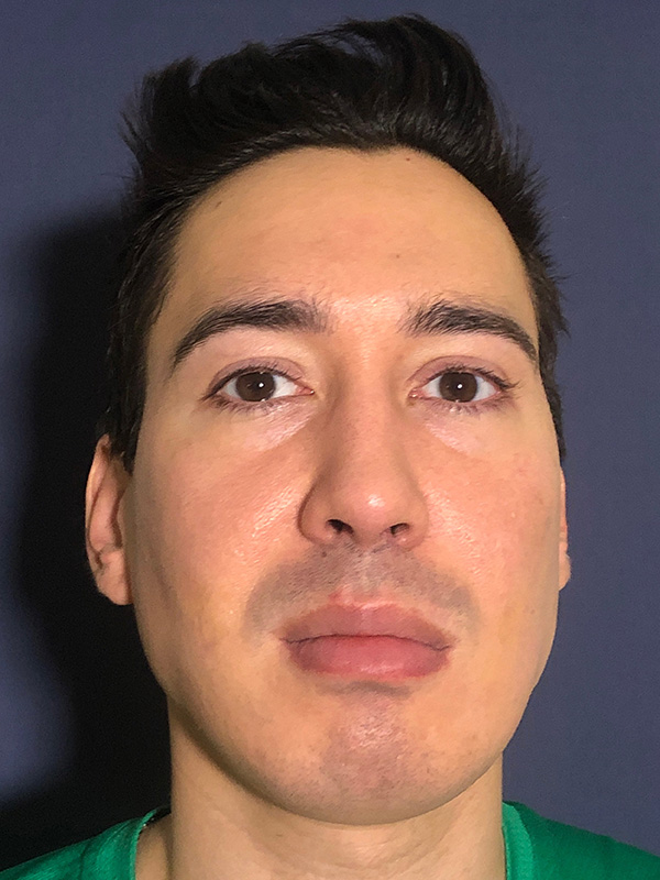 Patient 144612456 | Scar Treatment Before and After | Alizadeh