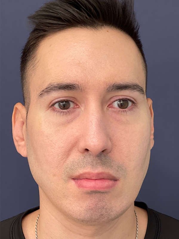 Patient 144612456 | Scar Treatment Before and After | Alizadeh