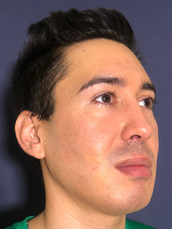 Patient 144612456 | Scar Treatment Before and After | Alizadeh