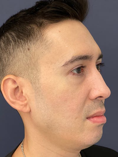 Sculptra™ Before & After Gallery - Patient 144612455 - Image 4