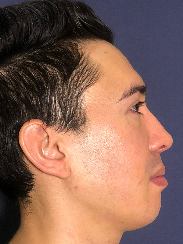 Patient 144612456 | Scar Treatment Before and After | Alizadeh