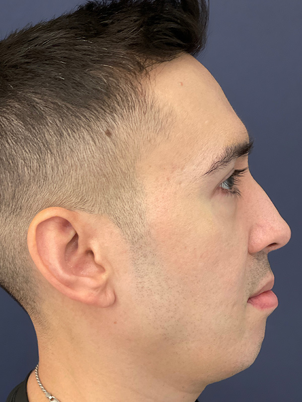 Patient 144612456 | Scar Treatment Before and After | Alizadeh