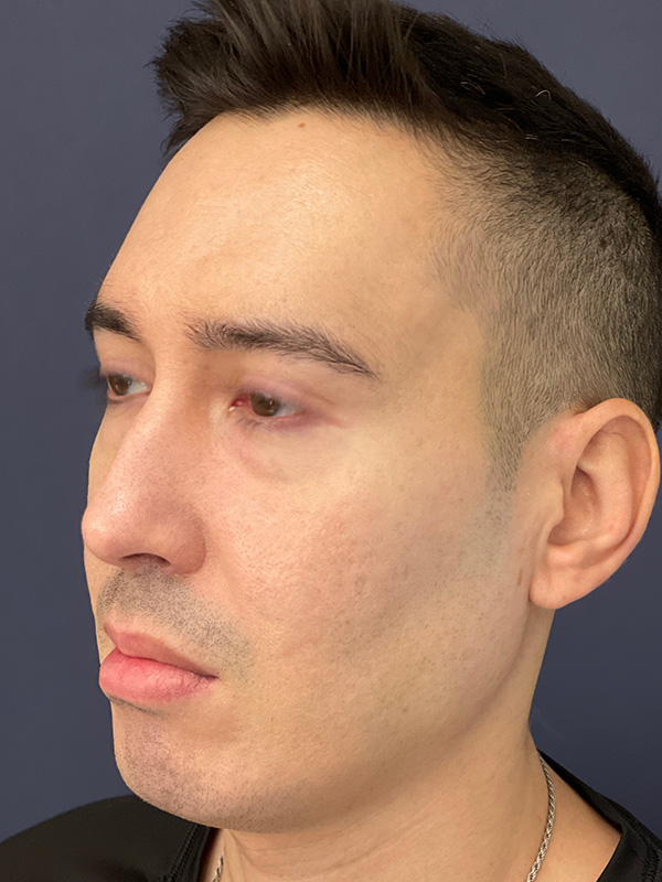 Patient 144612456 | Scar Treatment Before and After | Alizadeh