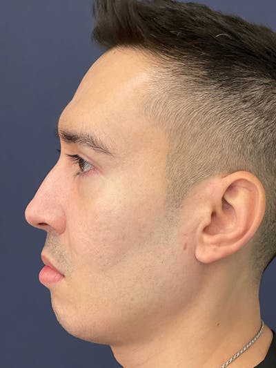 Sculptra™ Before & After Gallery - Patient 144612455 - Image 10