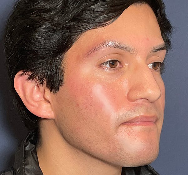  Liquid Rhinoplasty Before & After Gallery - Patient 145833089 - Image 9
