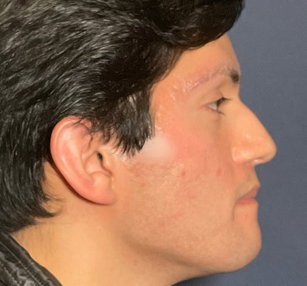  Liquid Rhinoplasty Before & After Gallery - Patient 145833089 - Image 5