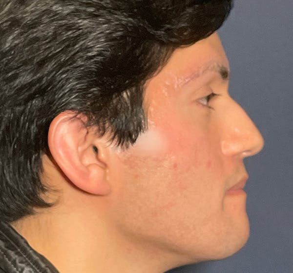  Liquid Rhinoplasty Before & After Gallery - Patient 145833089 - Image 5